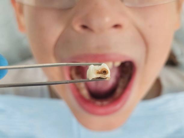 Best Emergency Dentist for Lost Fillings or Crowns in Hayward, CA